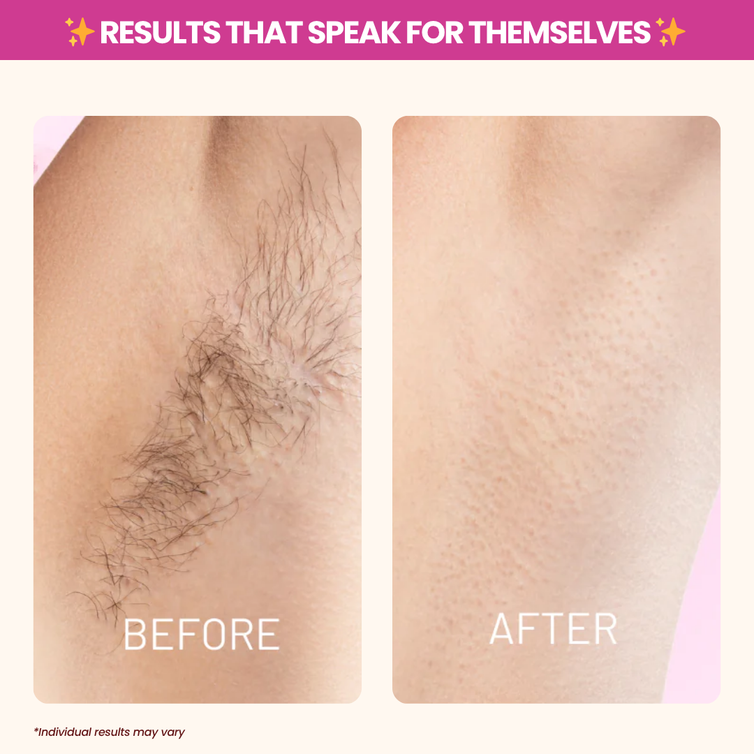 🎄 Christmas Sale Event - Cyperus Rotundus Oil for Hair Reduction