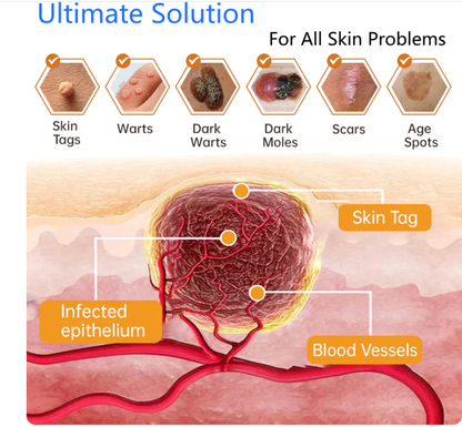 Hot Sale 49% off - Non-Invasive Mole and Wart Removal Laser Pen