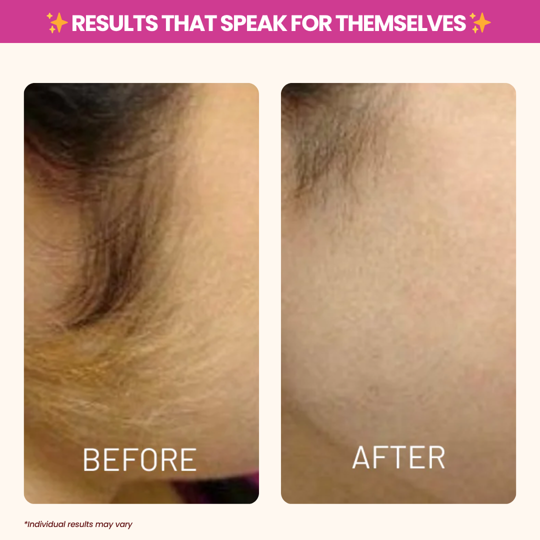 🎄 Christmas Sale Event - Cyperus Rotundus Oil for Hair Reduction