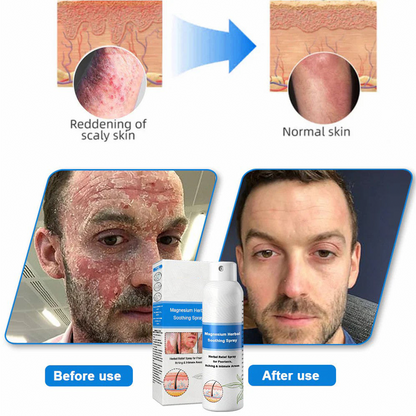 ✅ Official Store: HZA™ Magnesium Herbal Psoriasis Spray ⚕️ FDA Certified