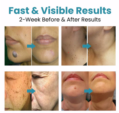 Hot Sale 49% off - Non-Invasive Mole and Wart Removal Laser Pen