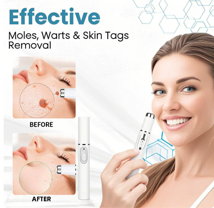 Hot Sale 49% off - Non-Invasive Mole and Wart Removal Laser Pen