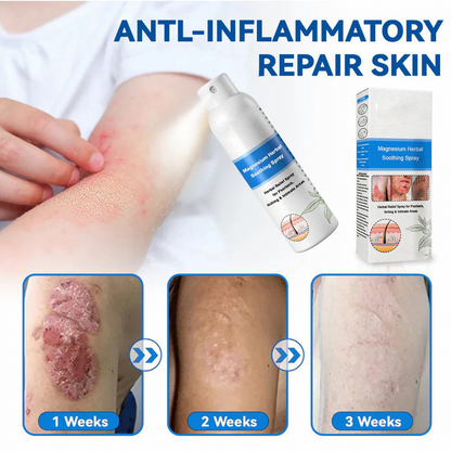 ✅ Official Store: HZA™ Magnesium Herbal Psoriasis Spray ⚕️ FDA Certified