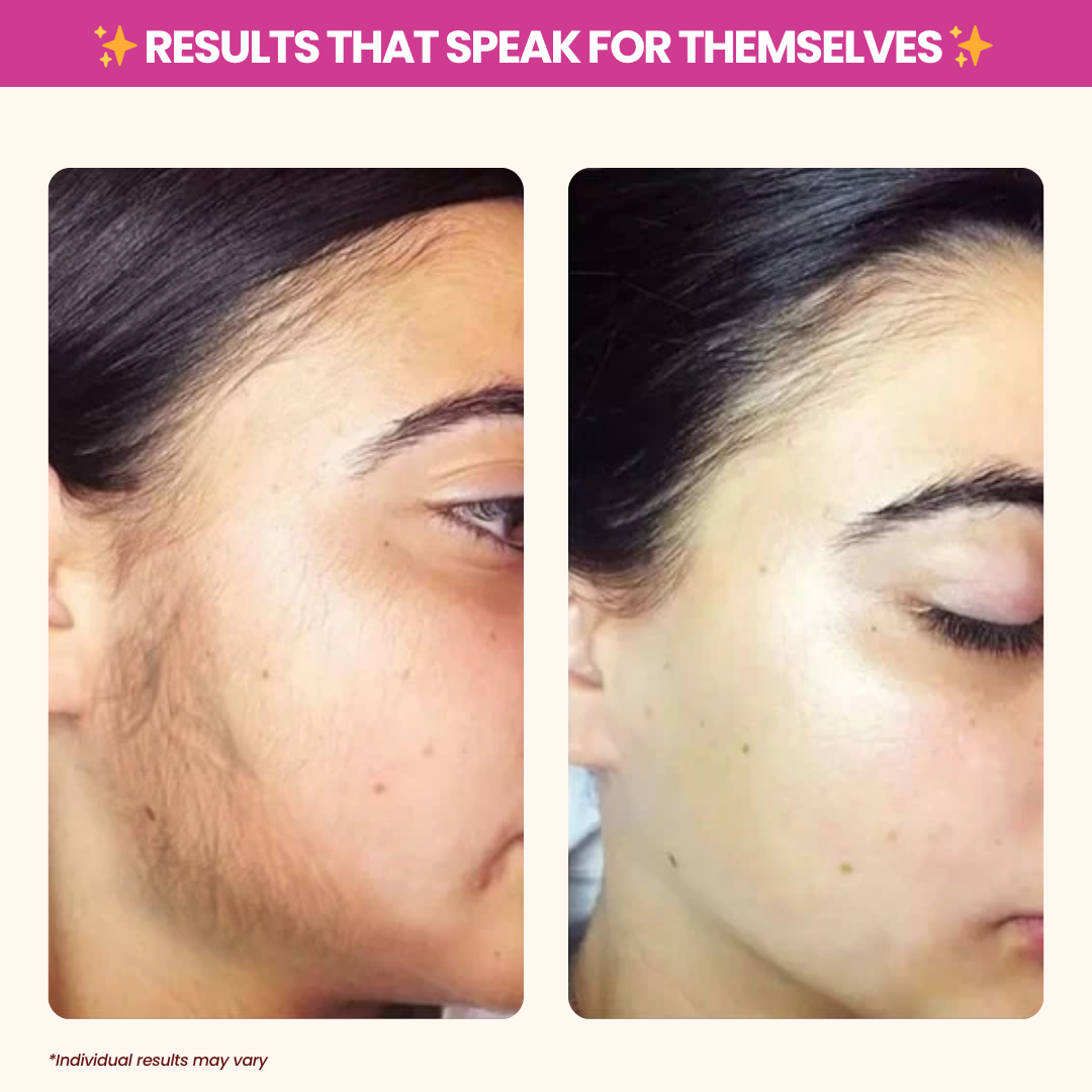 🎄 Christmas Sale Event - Cyperus Rotundus Oil for Hair Reduction