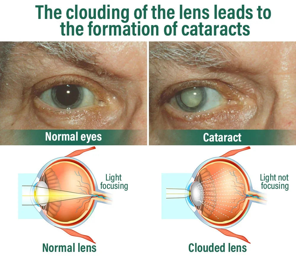 Eyeworldpark™ Nano Vision Repair Eye Serum ✅FDA Approved(Suitable for presbyopia, dry eye syndrome, glaucoma, and cataracts)