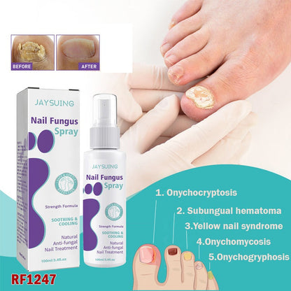 PLANT-BASED ANTI-FUNGAL SPRAY (Clinically Approved)