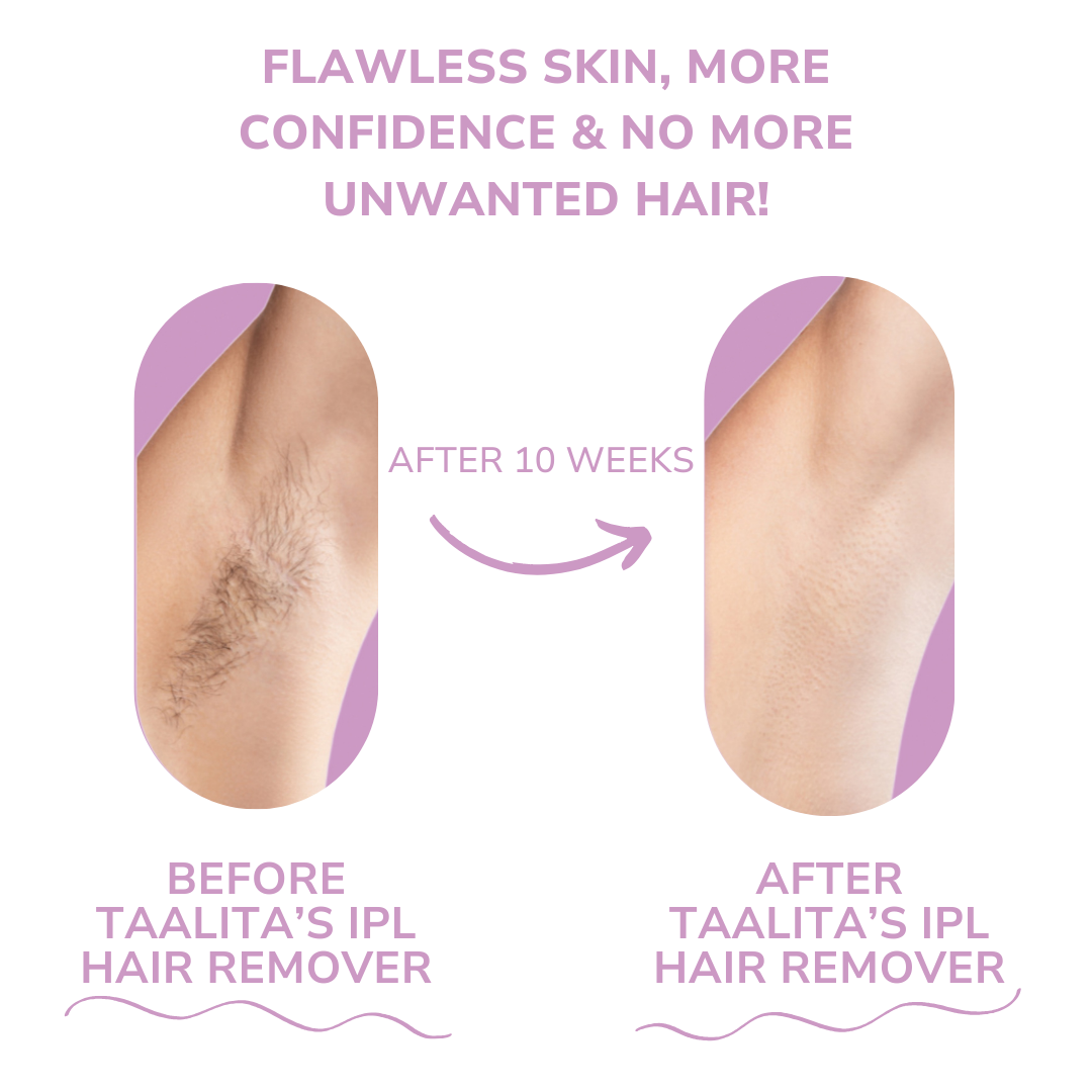 IPL Hair Remover I The leading laser hair removal for your home