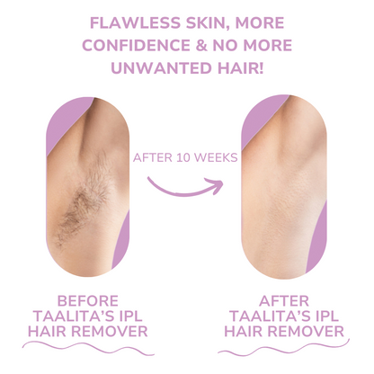 IPL Hair Remover I The leading laser hair removal for your home