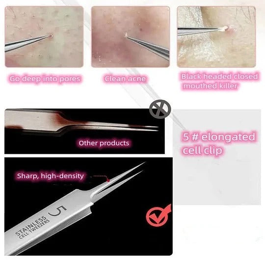 HOT SALE 49% off - Professional Facial Blackhead Remover Tweezers